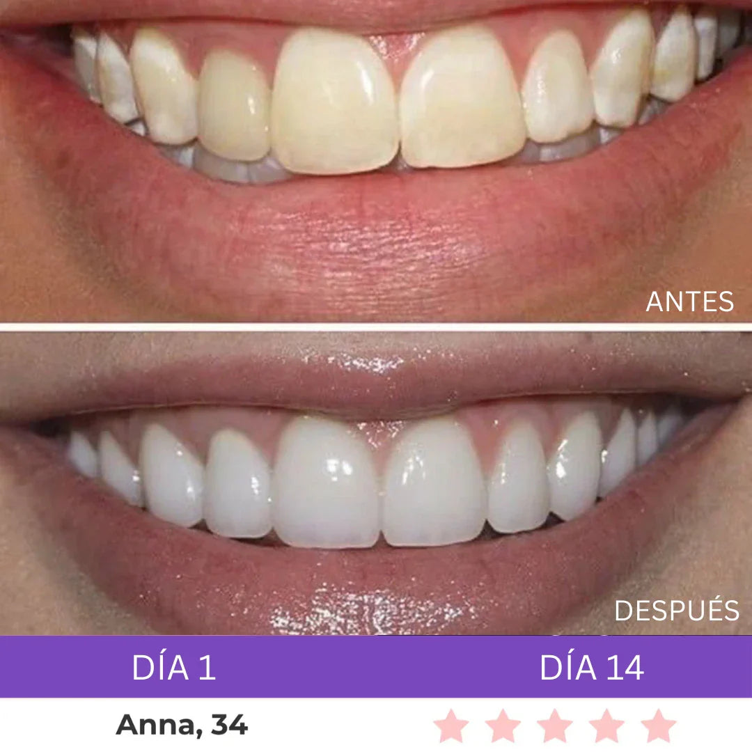 Combo Blanqueador LED + Gel V34® - Blanqueamiento Rápido en Casa