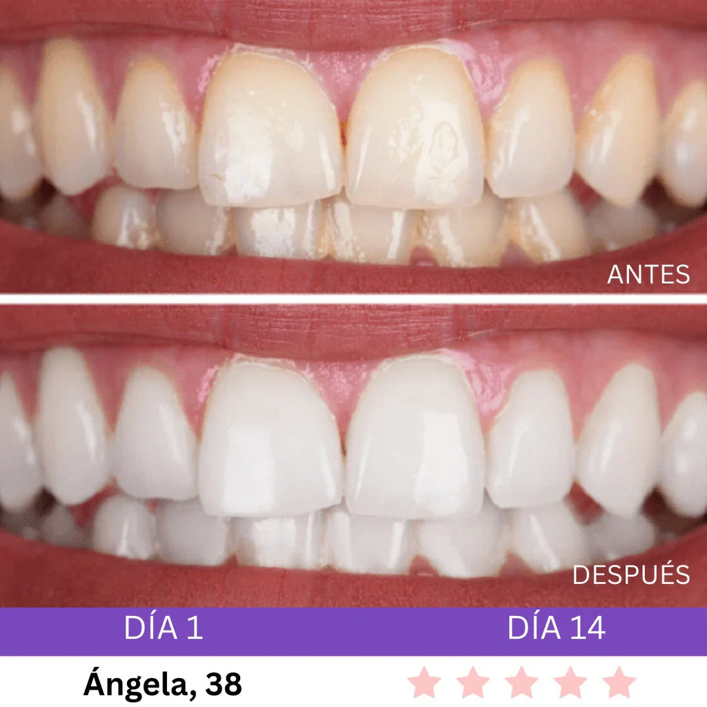 Combo Blanqueador LED + Gel V34® - Blanqueamiento Rápido en Casa