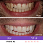 Combo Blanqueador LED + Gel V34® - Blanqueamiento Rápido en Casa