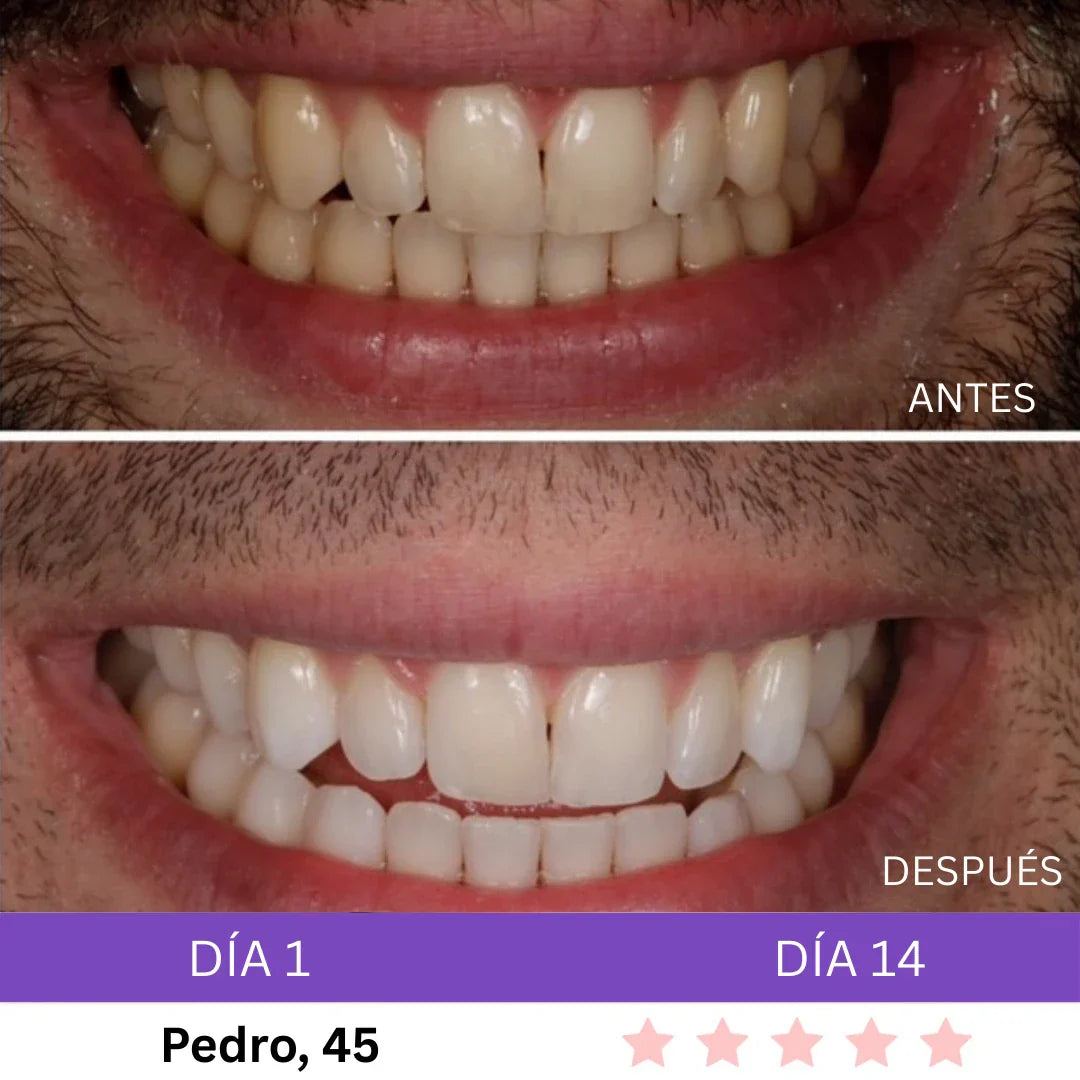 Combo Blanqueador LED + Gel V34® - Blanqueamiento Rápido en Casa