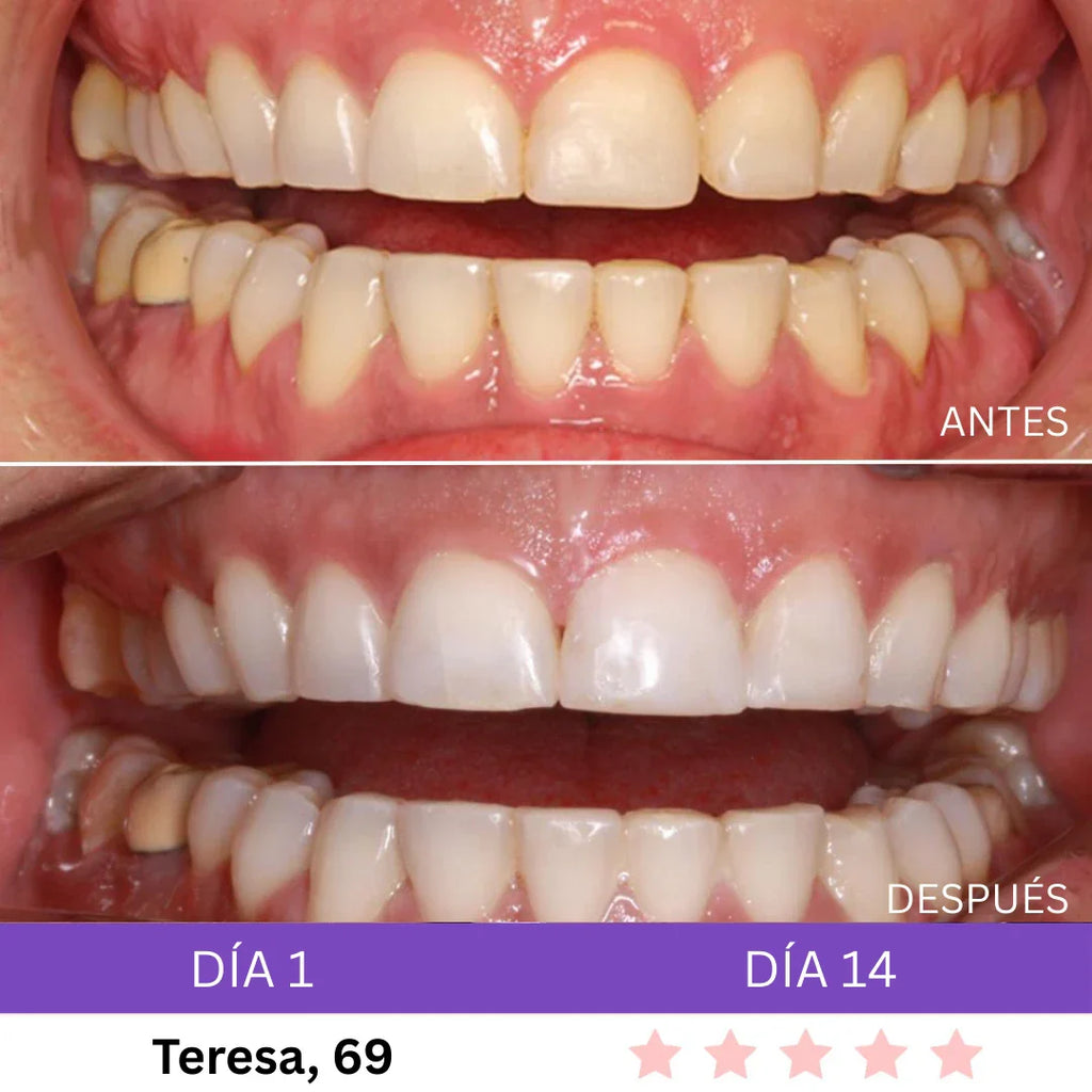 Combo Blanqueador LED + Gel V34® - Blanqueamiento Rápido en Casa