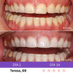 Combo Blanqueador LED + Gel V34® - Blanqueamiento Rápido en Casa