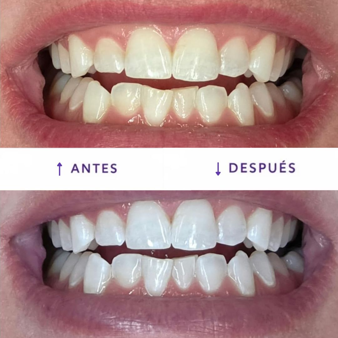 Tiras Blanqueadoras para Dientes – Sonrisa Más Blanca al Instante