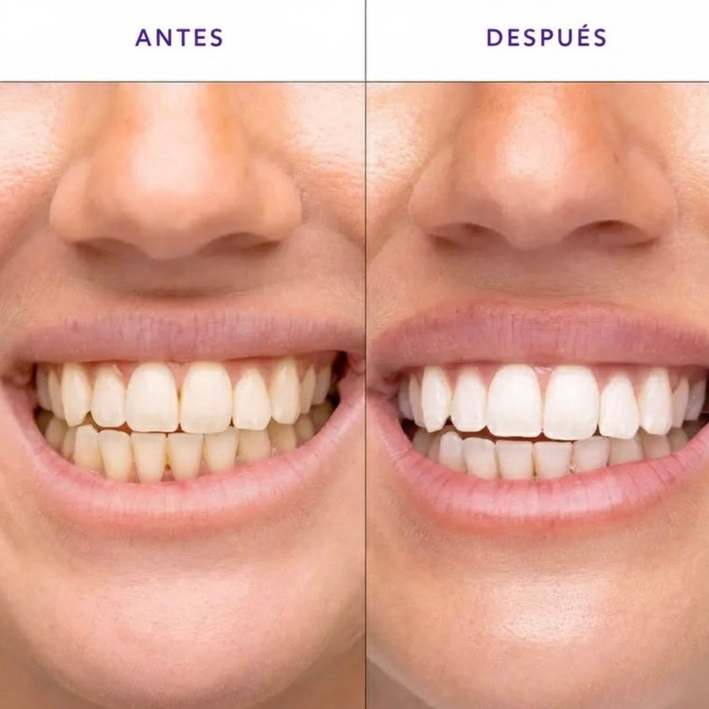 Tiras Blanqueadoras para Dientes – Sonrisa Más Blanca al Instante